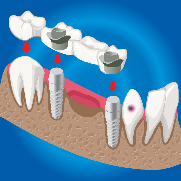 3D Guided Implant Surgery in Magarpatta City Hadapsar Pune