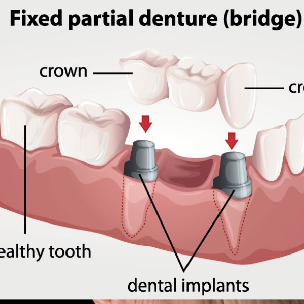 Routine Dental Checkup In Pune