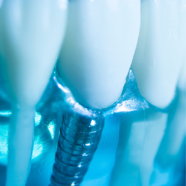 Teeth Whitening Dentist In Pune