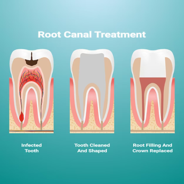 Root Canal Treatment in Magarpatta City Hadapsar Pune